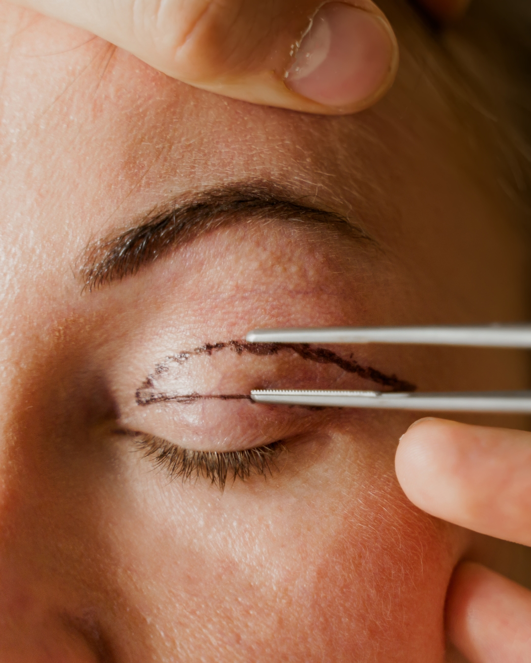 Ooglidcorrectie met chirurgische instrumenten